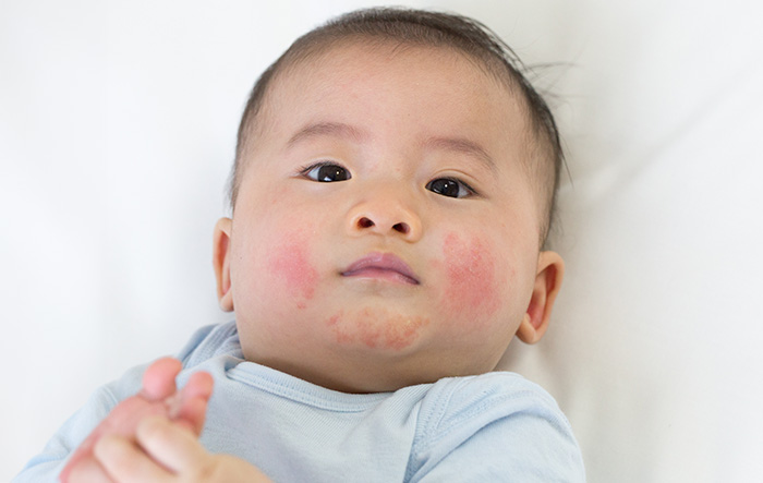 Kiddies  Pal Pediatrics | Preoperative Exams, Certified Mohel Brit and Asthma   Allergy Care